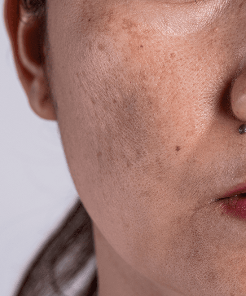 melasma